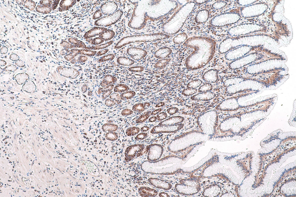 Immunohistochemical analysis of paraffin-embedded human stomach cancer tissue slide using KHC0853 (PA2G4 IHC Kit).