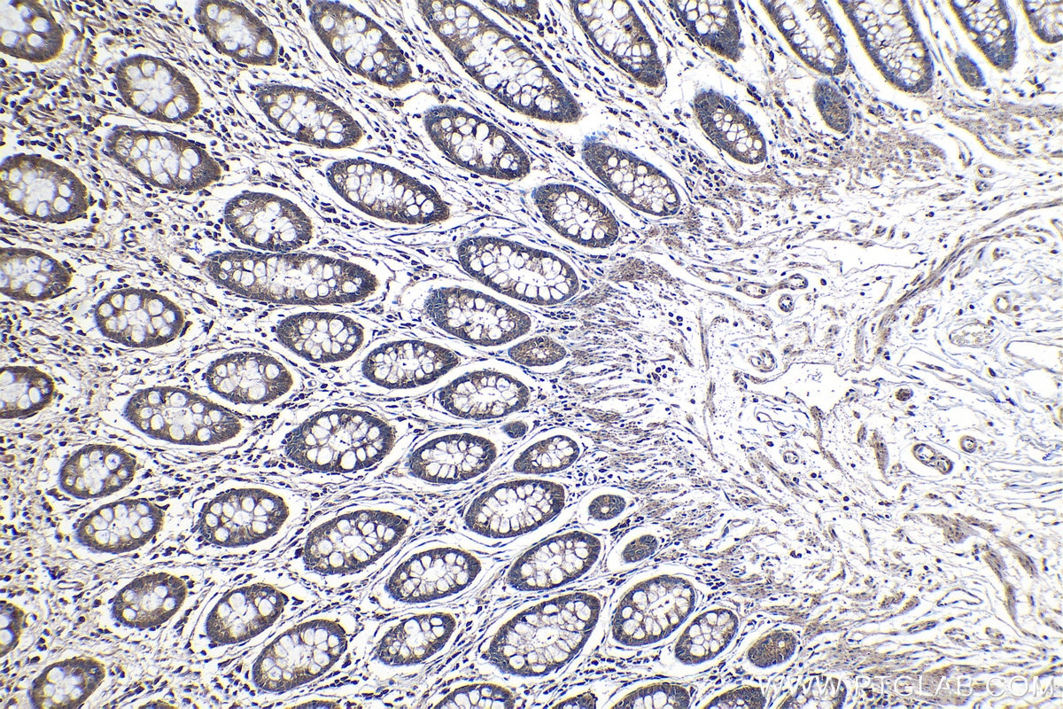 Immunohistochemical analysis of paraffin-embedded human colon tissue slide using KHC1141 (PABPC1 IHC Kit).