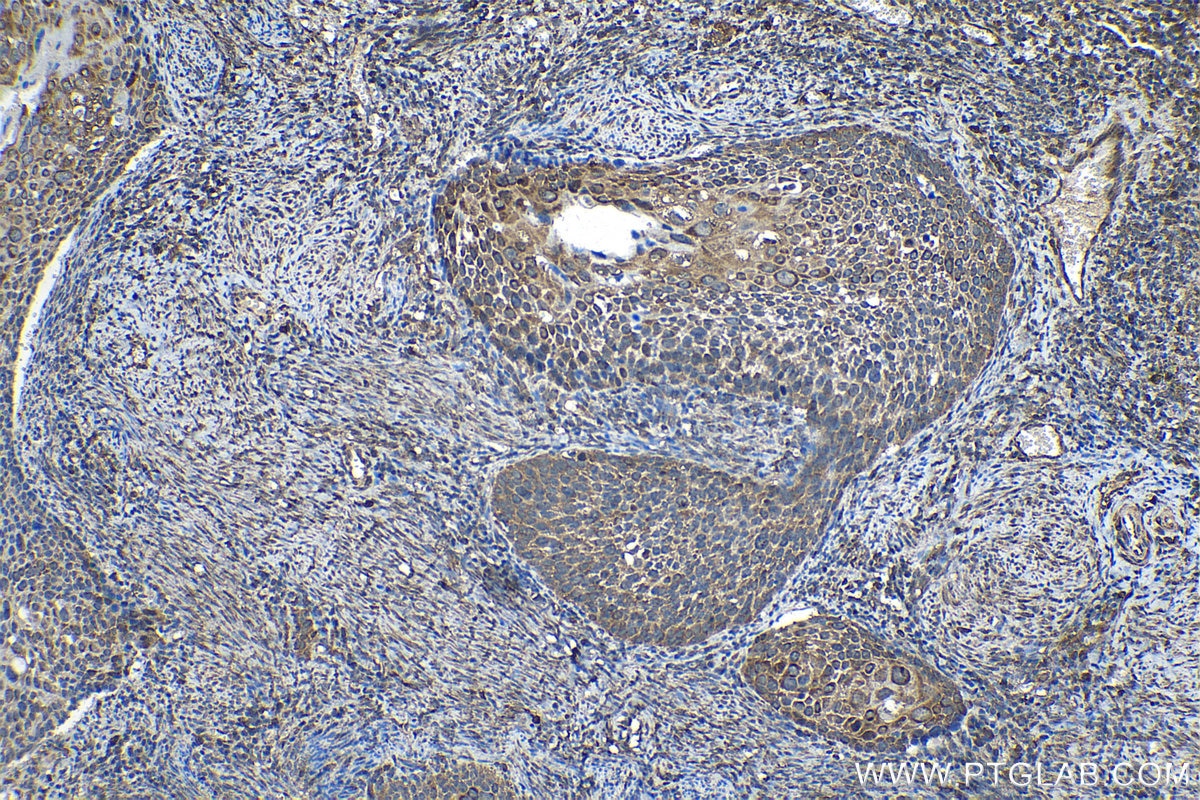 Immunohistochemical analysis of paraffin-embedded human cervical cancer tissue slide using KHC1141 (PABPC1 IHC Kit).