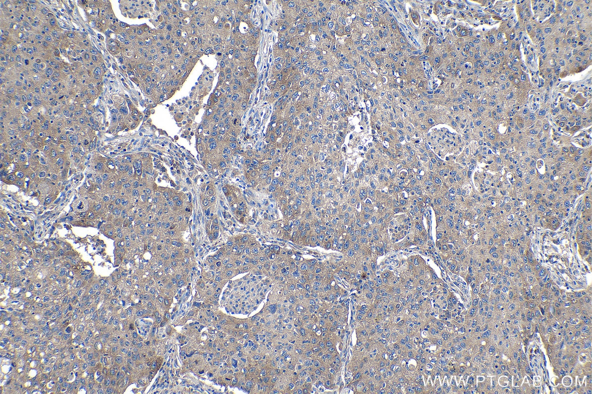 Immunohistochemical analysis of paraffin-embedded human lung cancer tissue slide using KHC1141 (PABPC1 IHC Kit).