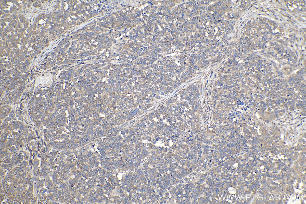 Immunohistochemical analysis of paraffin-embedded human ovary tumor tissue slide using KHC1141 (PABPC1 IHC Kit).