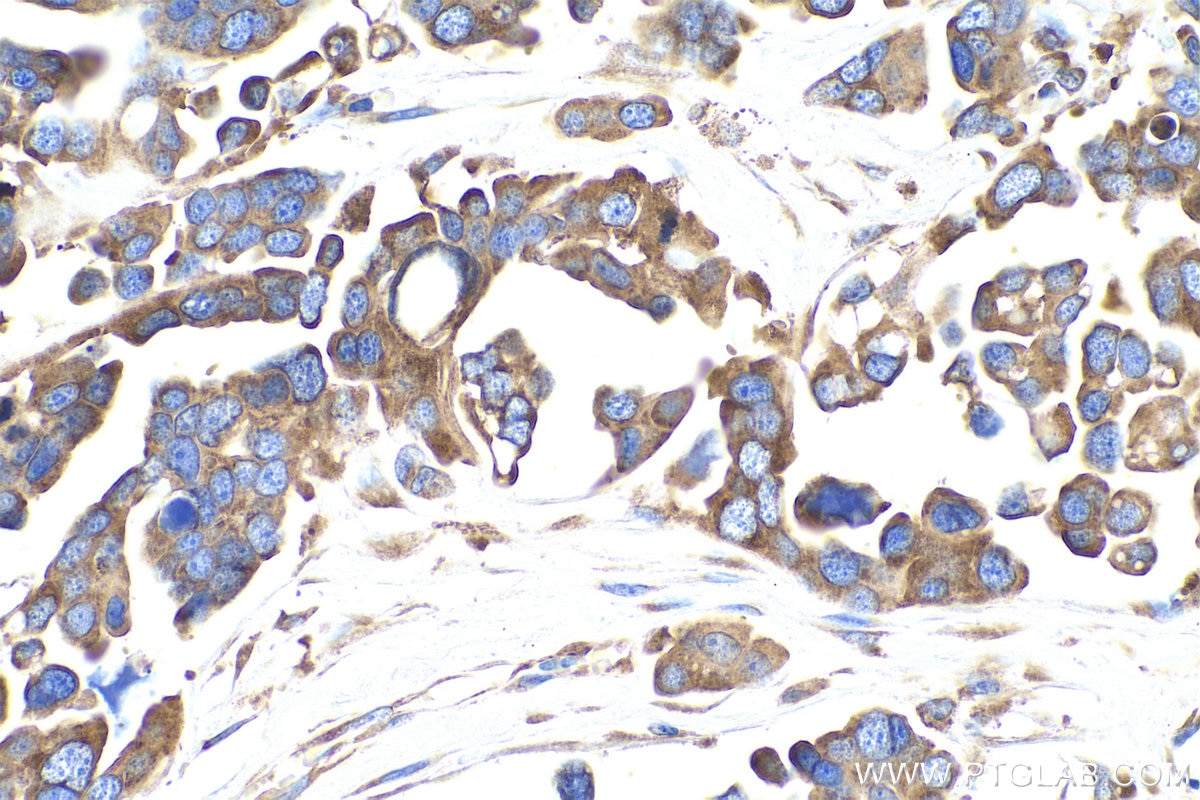 Immunohistochemical analysis of paraffin-embedded human colon cancer tissue slide using KHC0908 (PABPC4 IHC Kit).