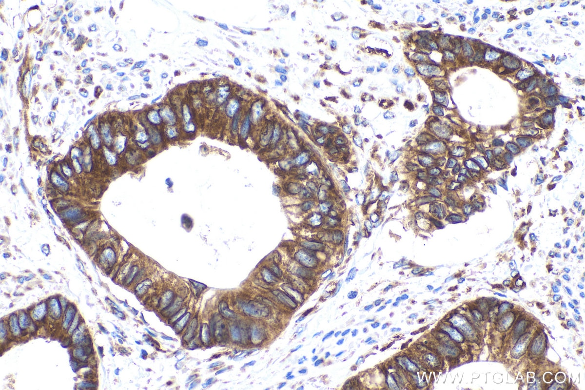 Immunohistochemical analysis of paraffin-embedded human urothelial carcinoma tissue slide using KHC0908 (PABPC4 IHC Kit).