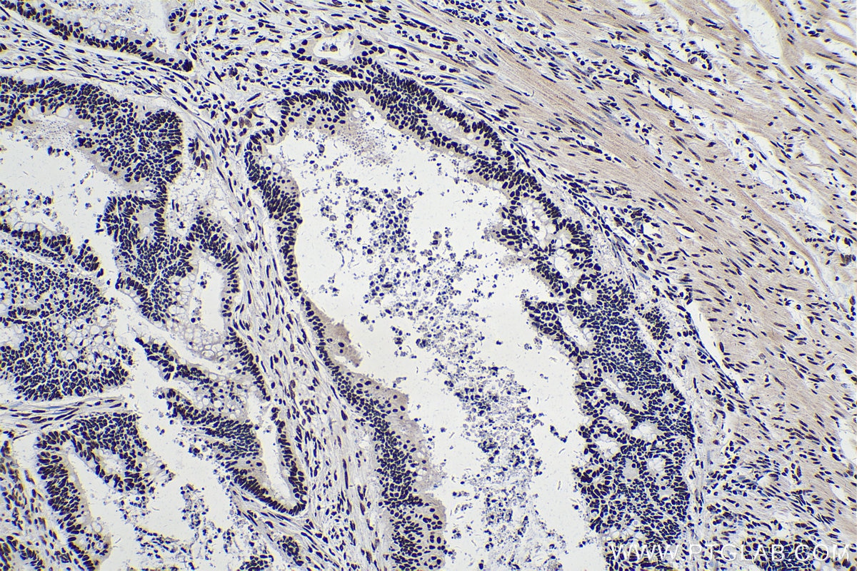 Immunohistochemical analysis of paraffin-embedded human colon cancer tissue slide using KHC0316 (PABPN1 IHC Kit).