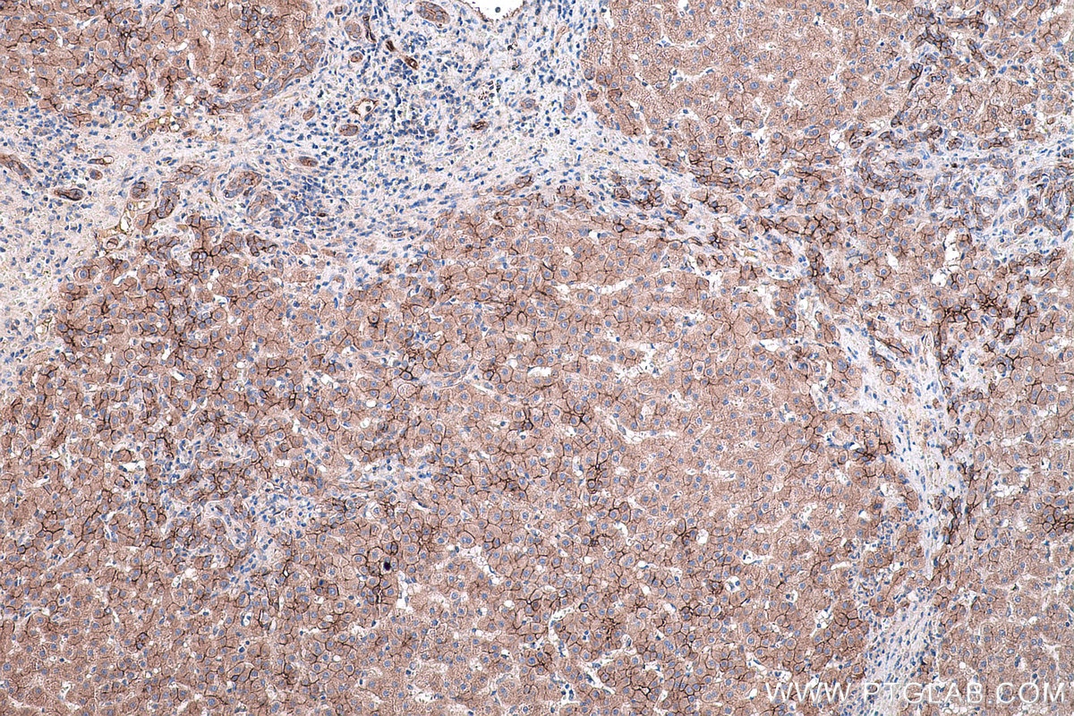 Immunohistochemical analysis of paraffin-embedded human liver cancer tissue slide using KHC0443 (PALMD IHC Kit).