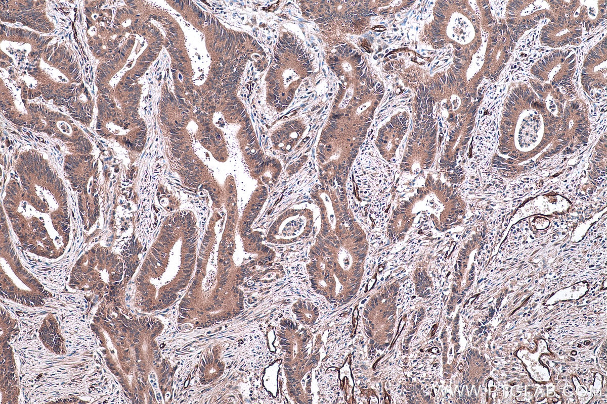 Immunohistochemical analysis of paraffin-embedded human colon cancer tissue slide using KHC0443 (PALMD IHC Kit).