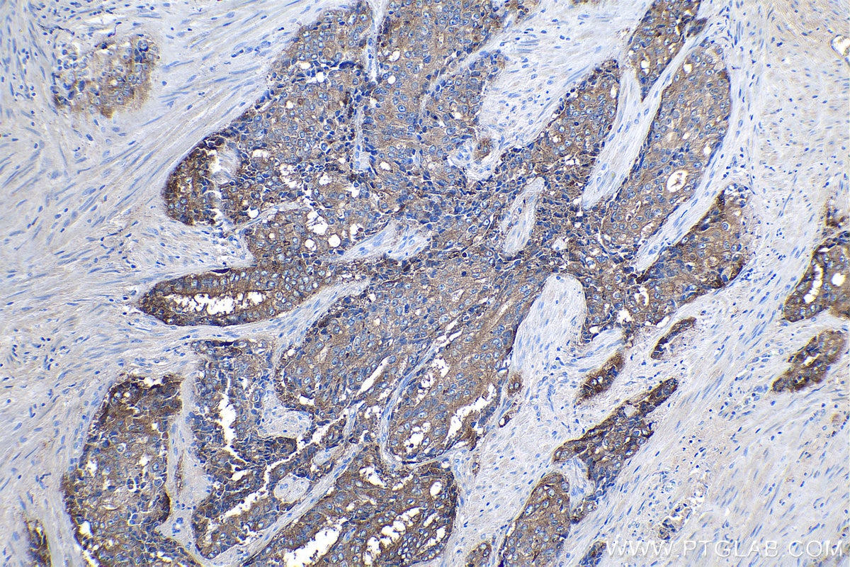 Immunohistochemical analysis of paraffin-embedded human prostate hyperplasia tissue slide using KHC1102 (PAP/ACPP IHC Kit).