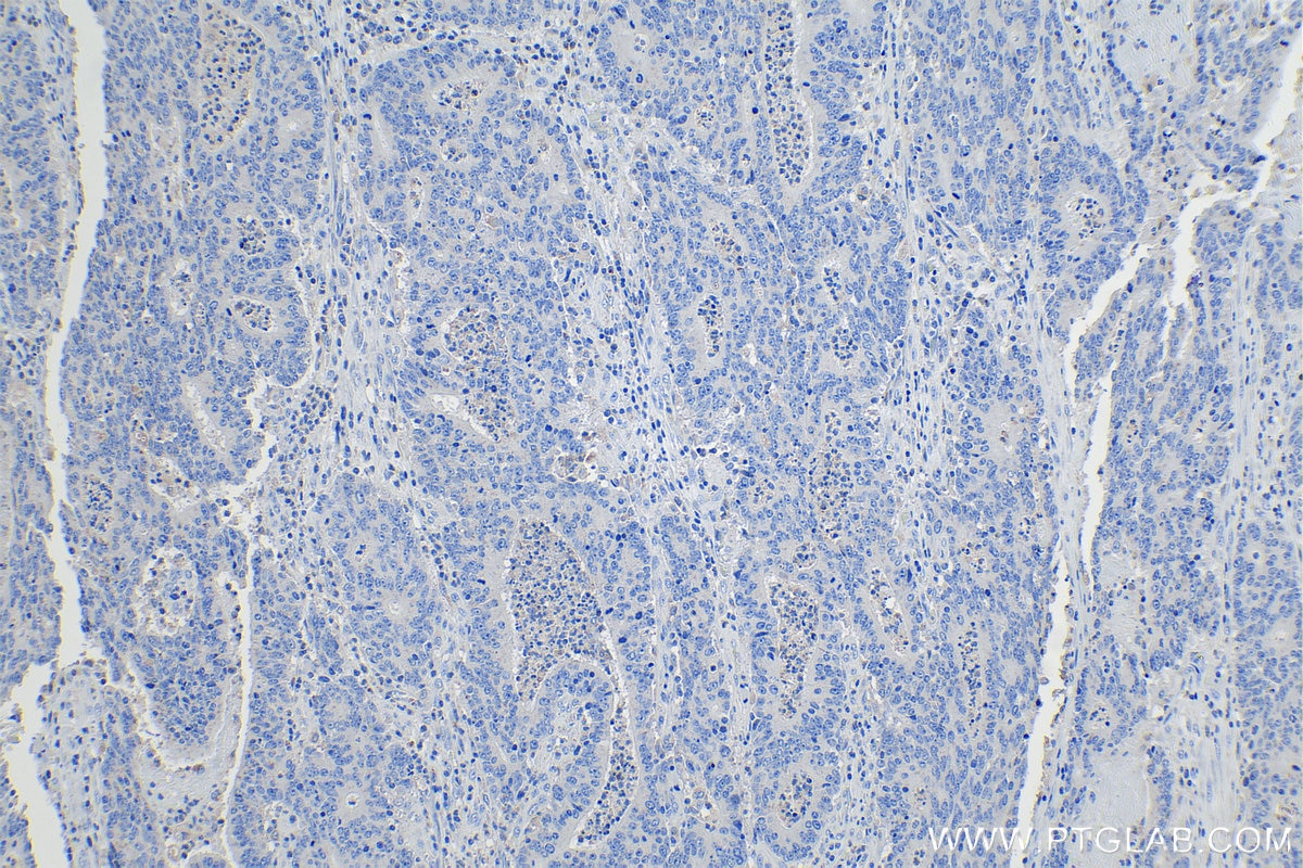 Immunohistochemical analysis of paraffin-embedded human colon cancer tissue slide (negative control) using KHC1102 (PAP/ACPP IHC Kit).