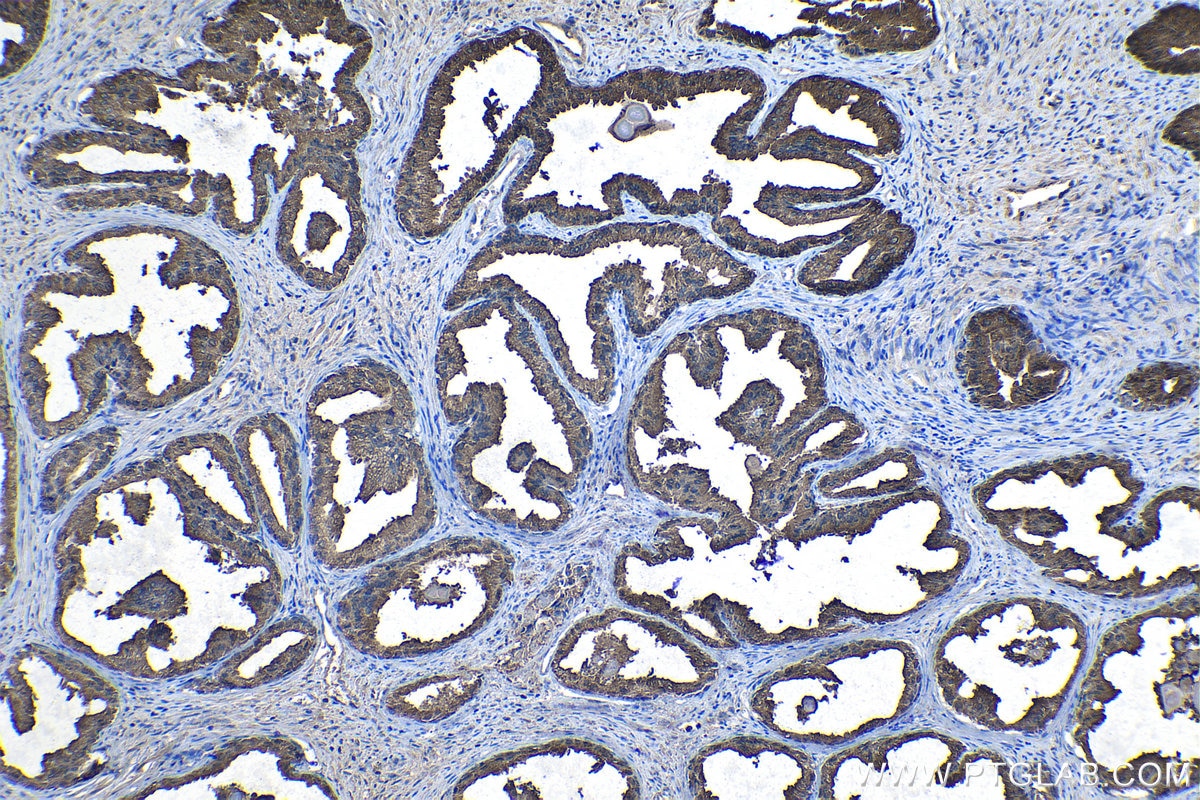 Immunohistochemical analysis of paraffin-embedded human prostate cancer tissue slide using KHC1102 (PAP/ACPP IHC Kit).