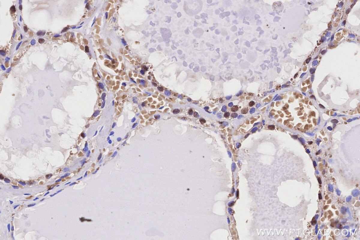 Immunohistochemical analysis of paraffin-embedded human thyroid cancer tissue slide using KHC3156 (PAPSS2 IHC Kit).