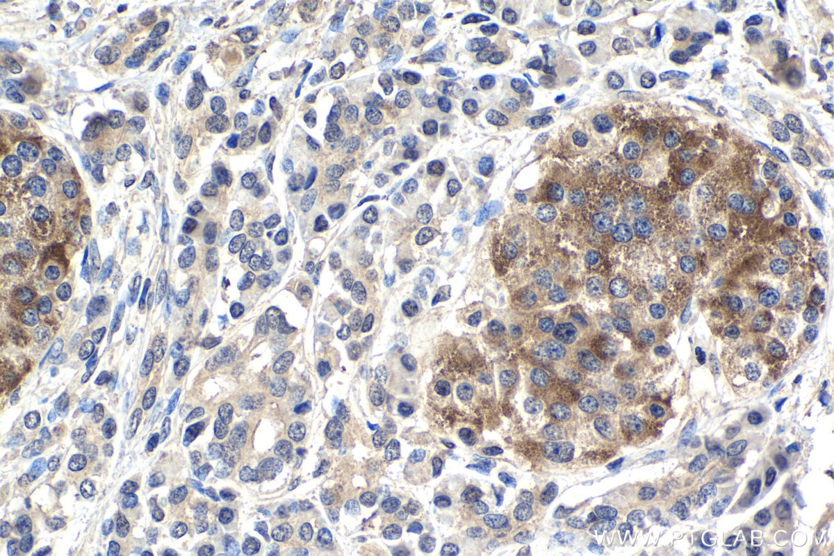 Immunohistochemical analysis of paraffin-embedded human pancreas cancer tissue slide using KHC1462 (PARK2 IHC Kit).