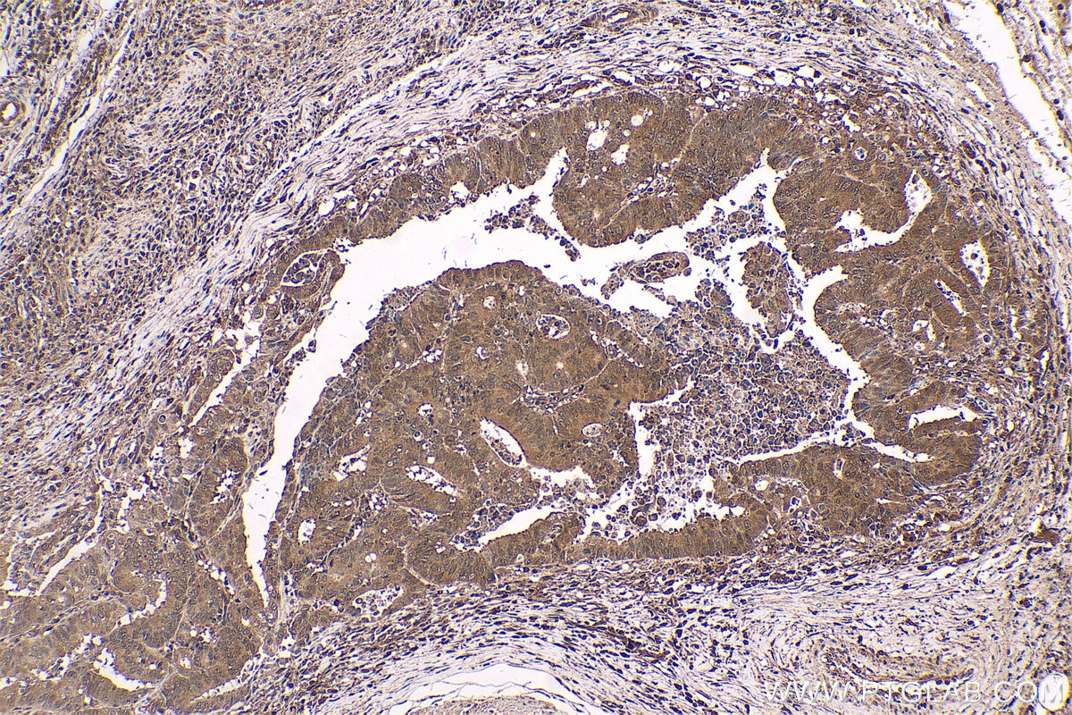 Immunohistochemical analysis of paraffin-embedded human colon cancer tissue slide using KHC0557 (PARK7 IHC Kit).