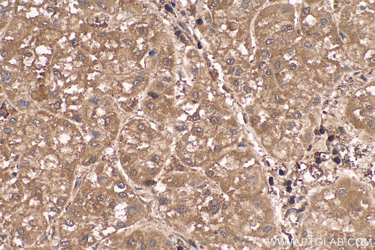 Immunohistochemical analysis of paraffin-embedded human liver cancer tissue slide using KHC0557 (PARK7 IHC Kit).
