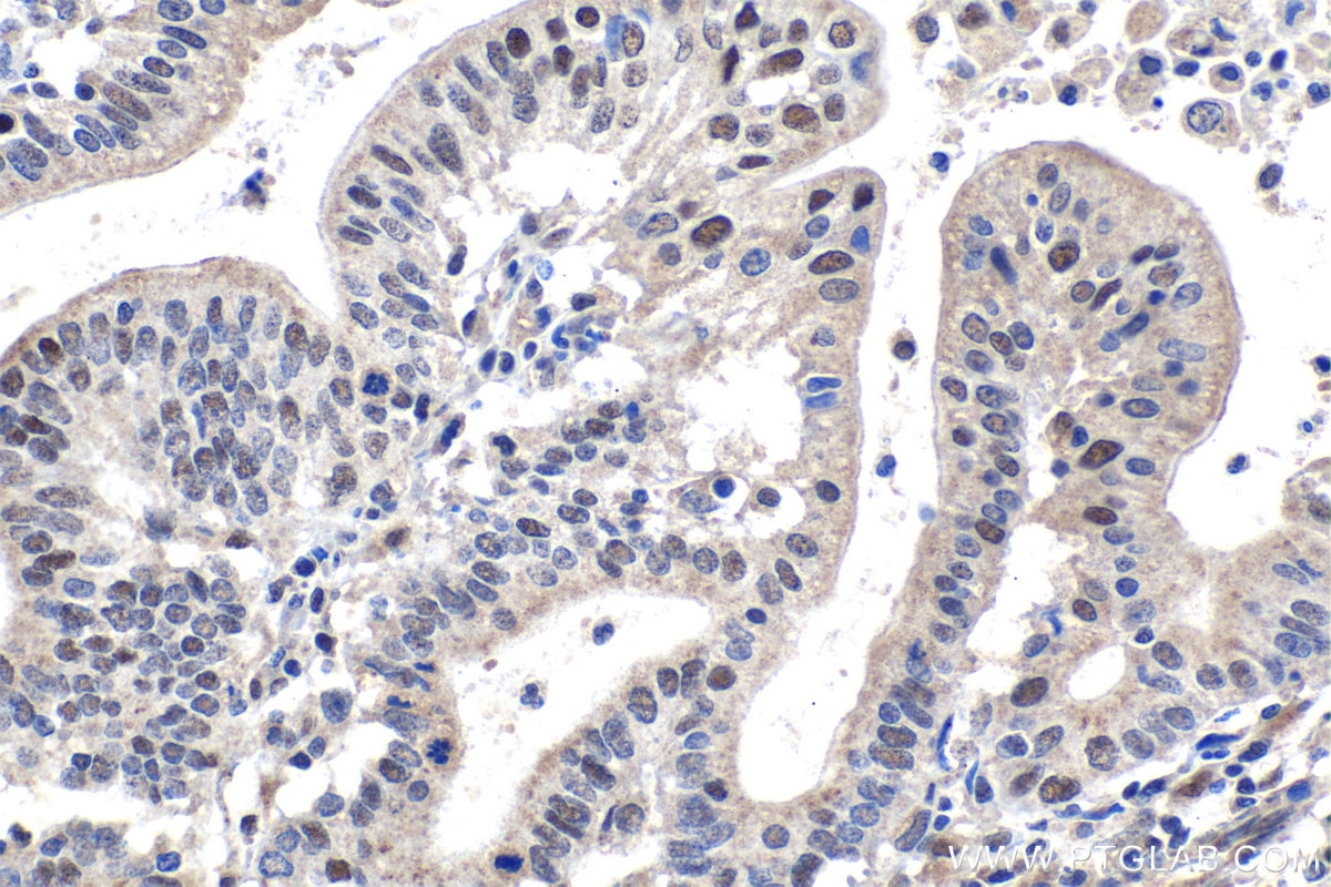 Immunohistochemical analysis of paraffin-embedded human endometrial cancer tissue slide using KHC1016 (PARN IHC Kit).