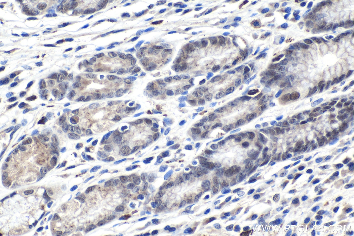 Immunohistochemical analysis of paraffin-embedded human stomach cancer tissue slide using KHC1016 (PARN IHC Kit).