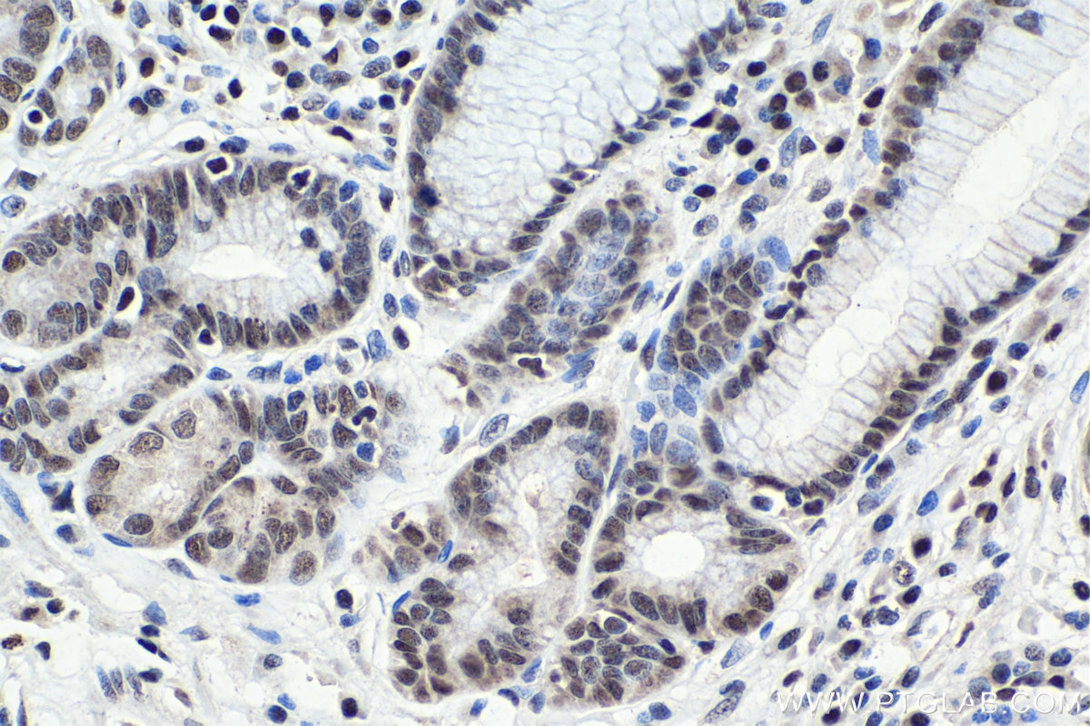 Immunohistochemical analysis of paraffin-embedded human stomach cancer tissue slide using KHC1069 (PARP1 IHC Kit).