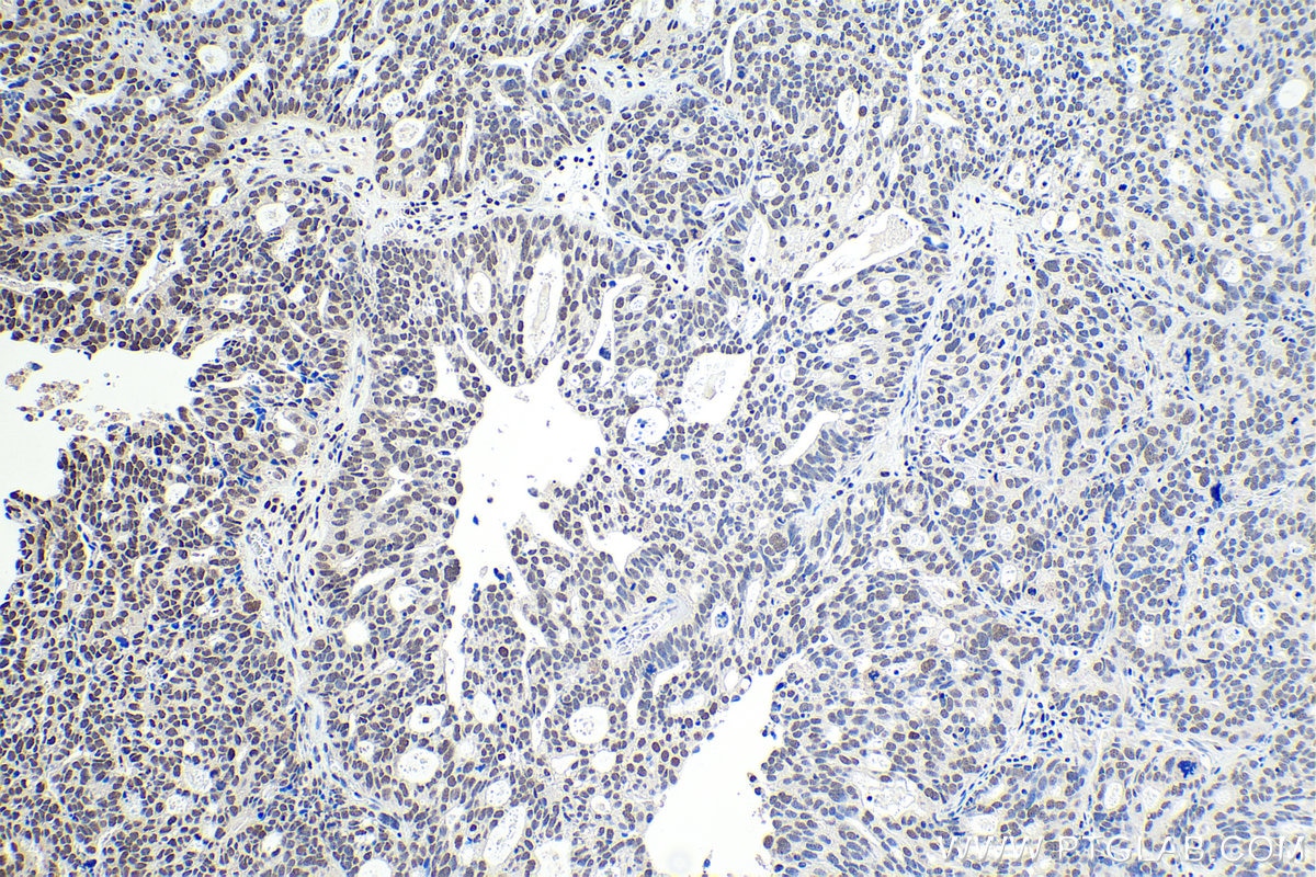 Immunohistochemical analysis of paraffin-embedded human ovary tumor tissue slide using KHC1069 (PARP1 IHC Kit).