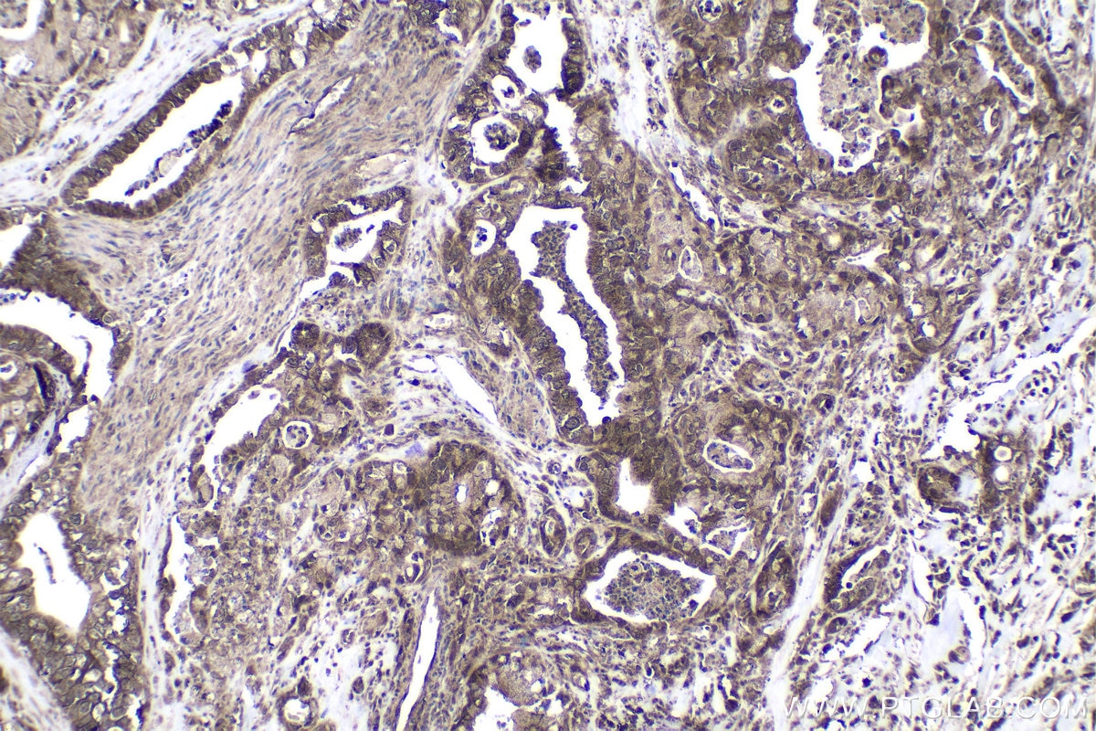 Immunohistochemical analysis of paraffin-embedded human pancreas cancer tissue slide using KHC1773 (PARP10 IHC Kit).