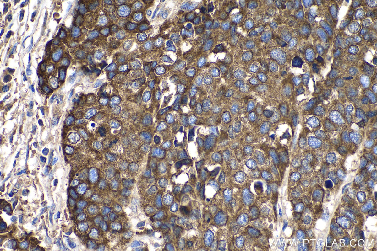 Immunohistochemical analysis of paraffin-embedded human stomach cancer tissue slide using KHC0720 (PARVA IHC Kit).