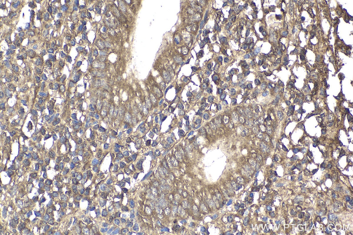 Immunohistochemical analysis of paraffin-embedded human appendicitis tissue slide using KHC1874 (PAWR IHC Kit).