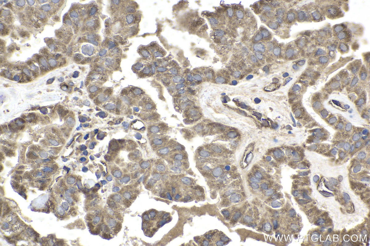 Immunohistochemical analysis of paraffin-embedded human thyroid cancer tissue slide using KHC1874 (PAWR IHC Kit).