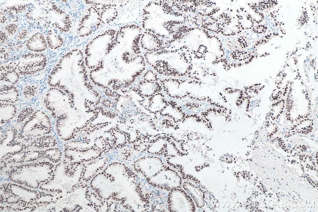 Immunohistochemical analysis of paraffin-embedded human ovary tumor tissue slide using KHC0038 (PAX8 IHC Kit).