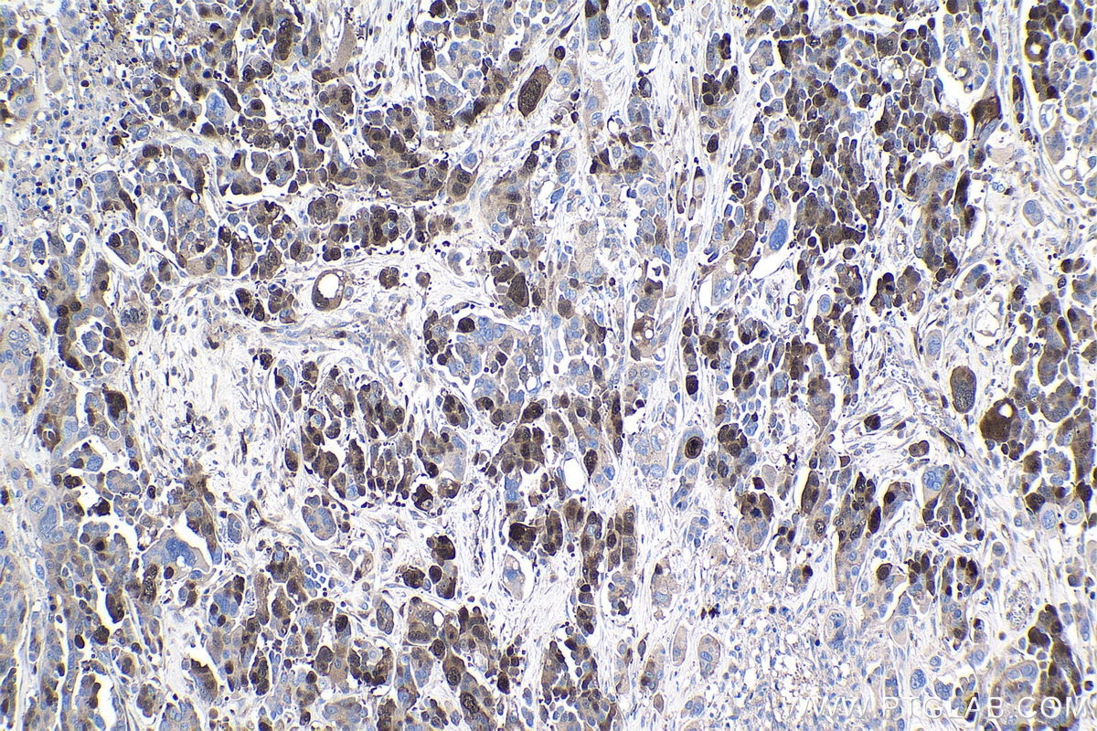 Immunohistochemical analysis of paraffin-embedded human colon cancer tissue slide using KHC1034 (PBK IHC Kit).