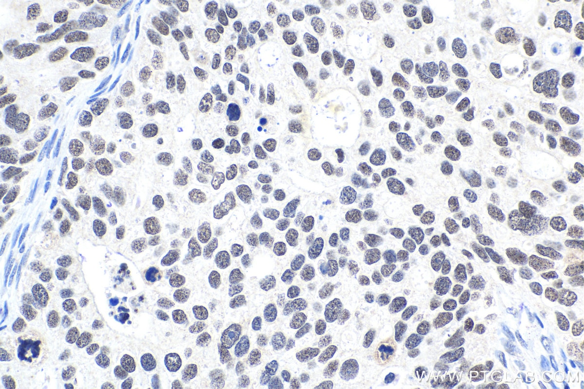 Immunohistochemical analysis of paraffin-embedded human ovary tumor tissue slide using KHC1815 (PBRM1 IHC Kit).