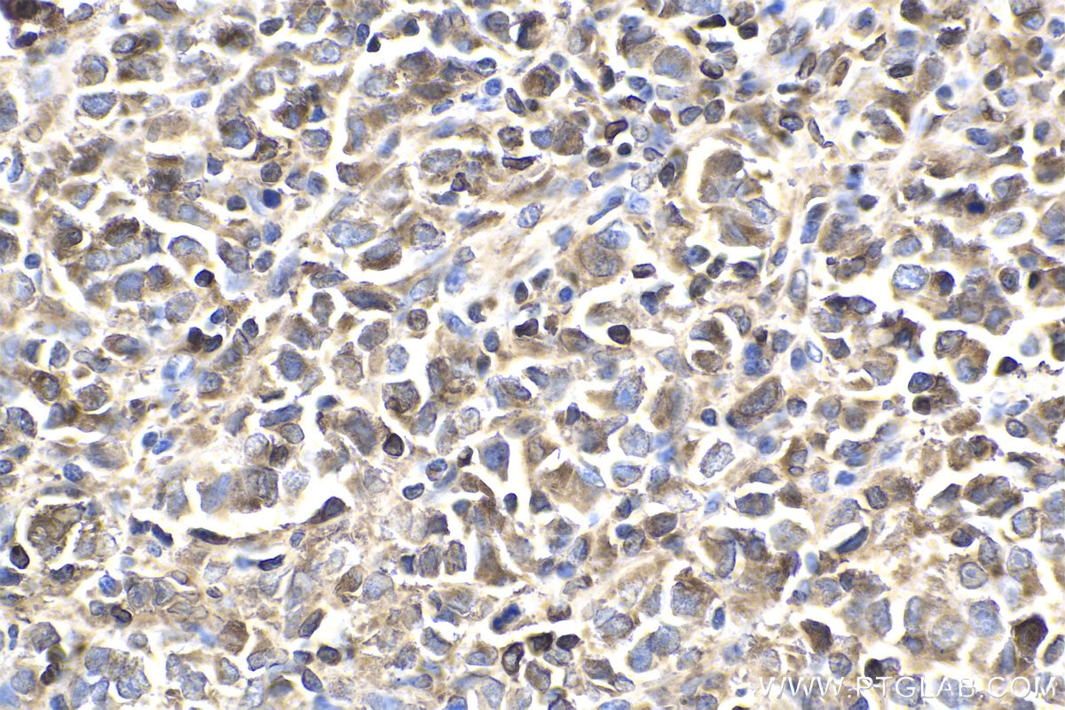 Immunohistochemical analysis of paraffin-embedded human malignant melanoma tissue slide using KHC1866 (PBXIP1 IHC Kit).