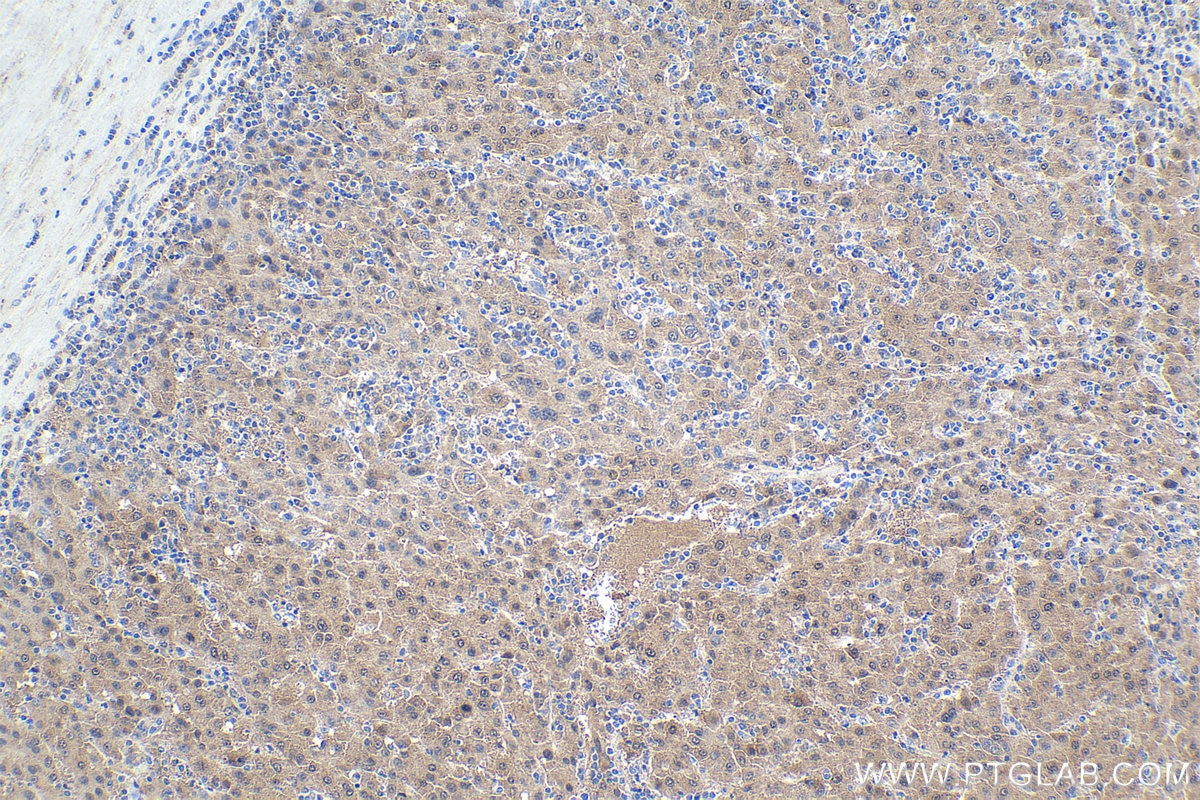 Immunohistochemical analysis of paraffin-embedded human liver cancer tissue slide using KHC1642 (PCBD1 IHC Kit).