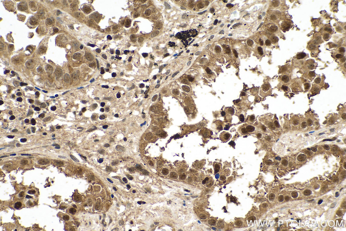 Immunohistochemical analysis of paraffin-embedded human lung cancer tissue slide using KHC0740 (PCBP1 IHC Kit).