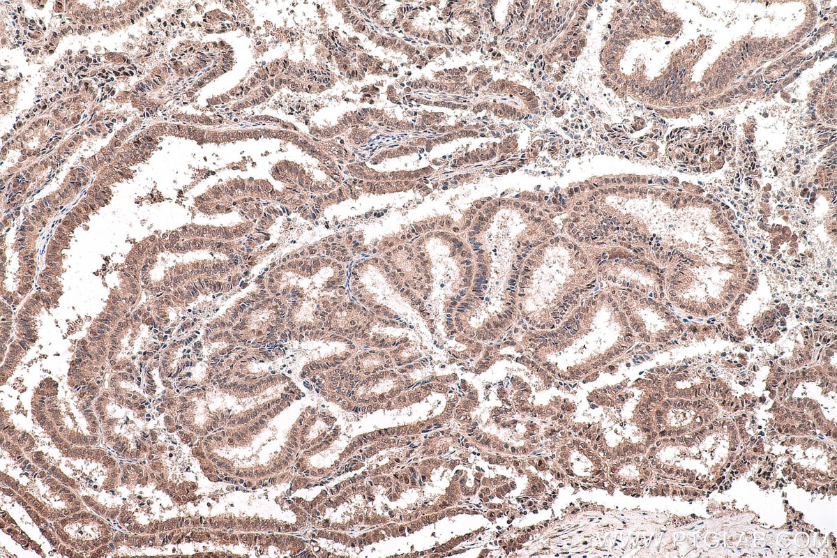 Immunohistochemical analysis of paraffin-embedded human ovary tumor tissue slide using KHC0740 (PCBP1 IHC Kit).