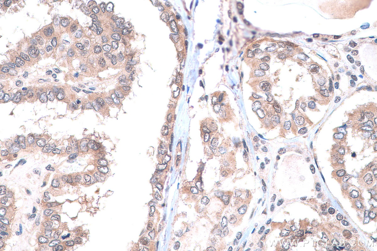 Immunohistochemical analysis of paraffin-embedded human thyroid cancer tissue slide using KHC0740 (PCBP1 IHC Kit).