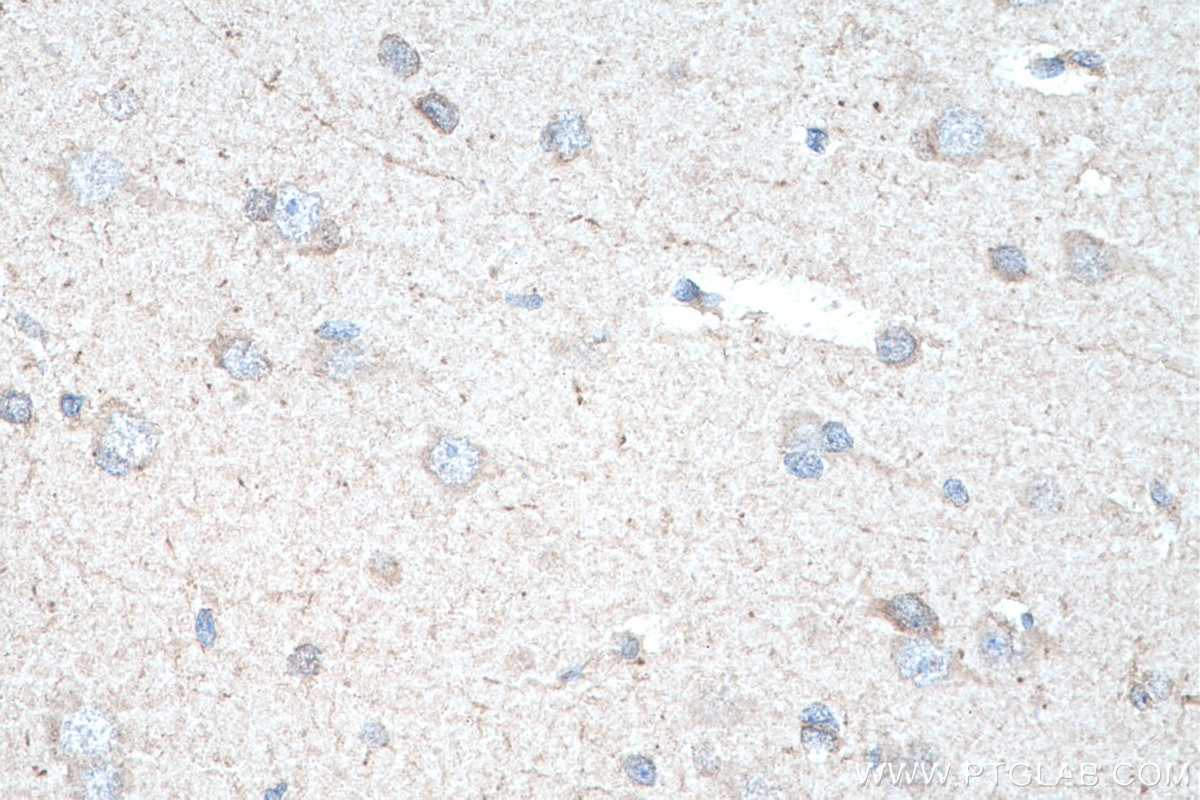 Immunohistochemical analysis of paraffin-embedded human gliomas tissue slide using KHC0297 (PCDHA3 IHC Kit).