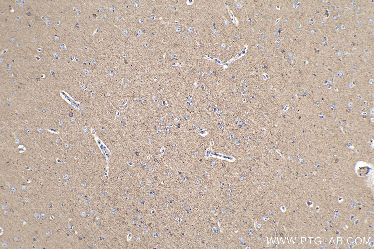 Immunohistochemical analysis of paraffin-embedded human gliomas tissue slide using KHC0256 (PCDHA5 IHC Kit).