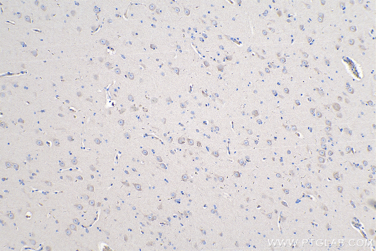 Immunohistochemical analysis of paraffin-embedded human gliomas tissue slide using KHC0257 (PCDHA6 IHC Kit).