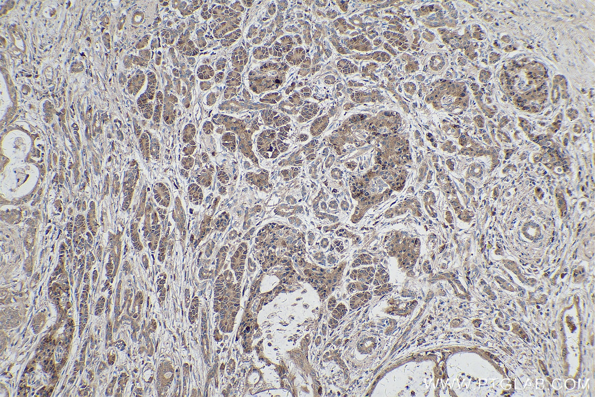 Immunohistochemical analysis of paraffin-embedded human pancreas cancer tissue slide using KHC0309 (PCDHB10 IHC Kit).