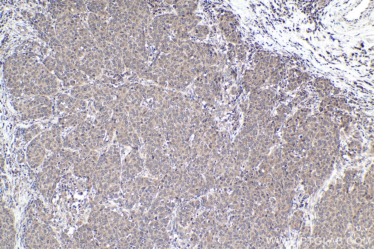 Immunohistochemical analysis of paraffin-embedded human stomach cancer tissue slide using KHC1775 (PCID2 IHC Kit).