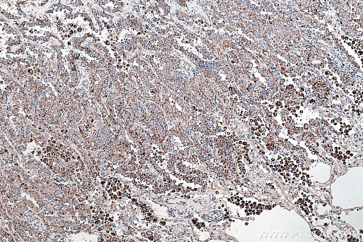 Immunohistochemical analysis of paraffin-embedded human lung cancer tissue slide using KHC0232 (PCK2 IHC Kit).