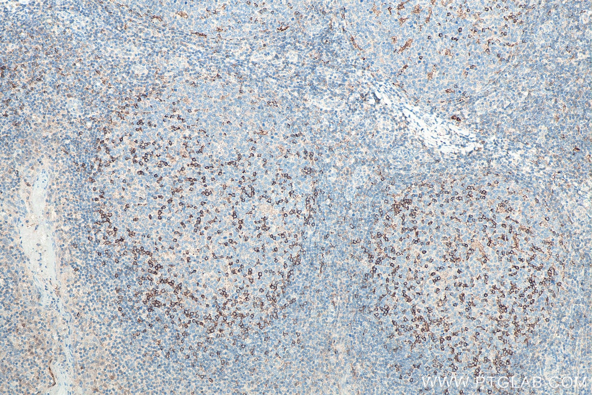 Immunohistochemical analysis of paraffin-embedded human tonsillitis tissue slide using KHC0064 (PD-1 IHC Kit).