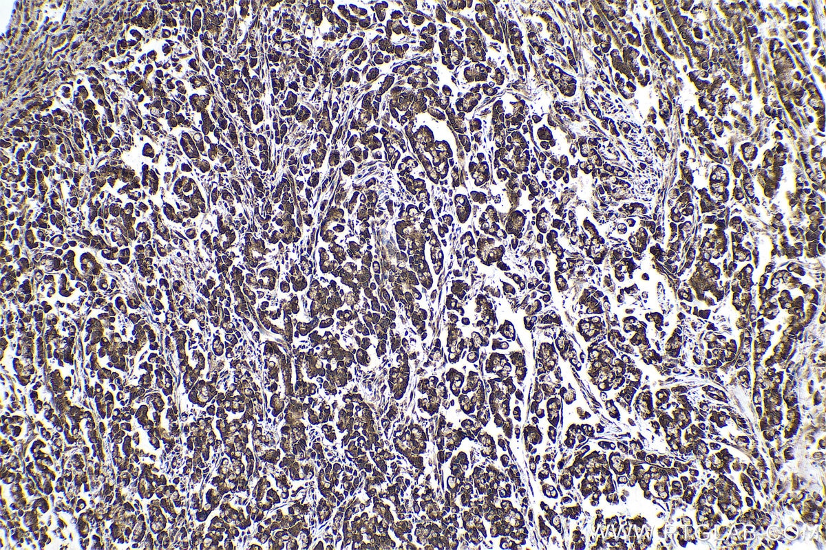 Immunohistochemical analysis of paraffin-embedded human colon cancer tissue slide using KHC0957 (PDAP1 IHC Kit).