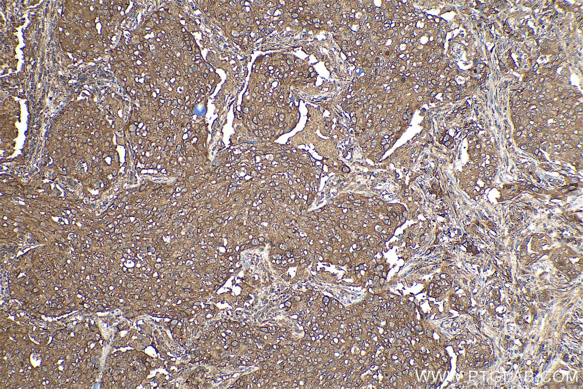 Immunohistochemical analysis of paraffin-embedded human lung cancer tissue slide using KHC0957 (PDAP1 IHC Kit).