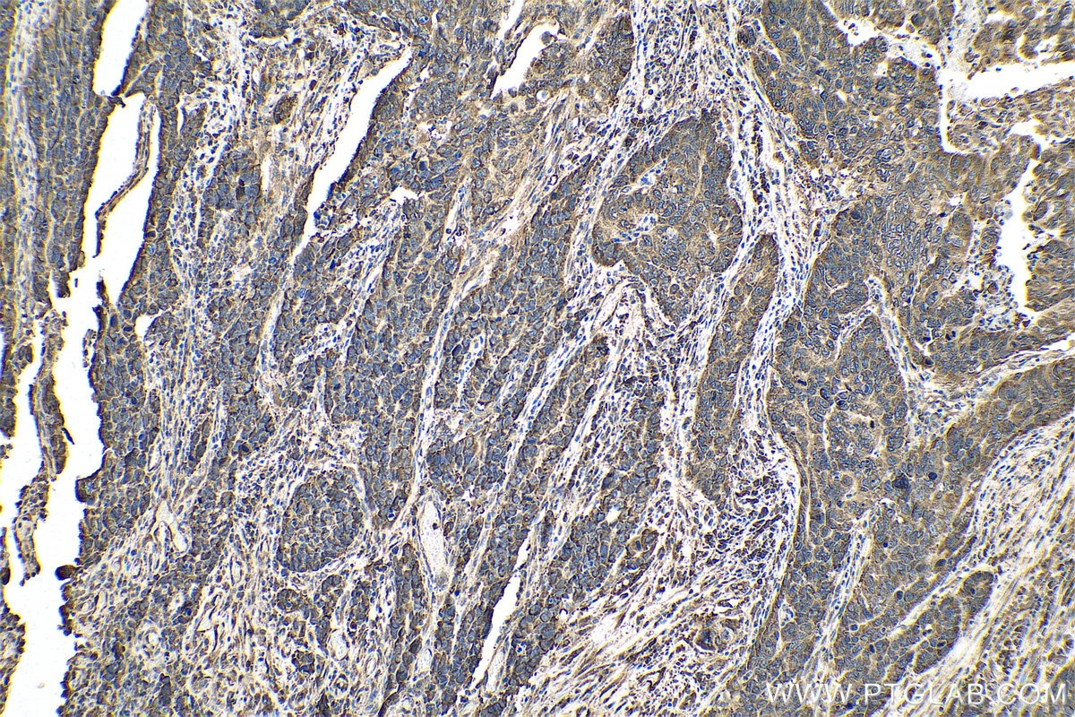 Immunohistochemical analysis of paraffin-embedded human stomach cancer tissue slide using KHC0957 (PDAP1 IHC Kit).