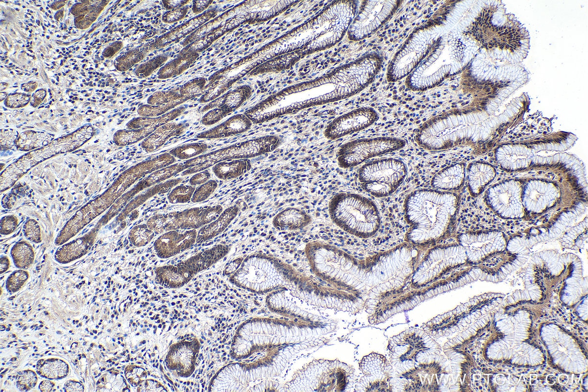 Immunohistochemical analysis of paraffin-embedded human stomach cancer tissue slide using KHC1048 (PDCD6 IHC Kit).