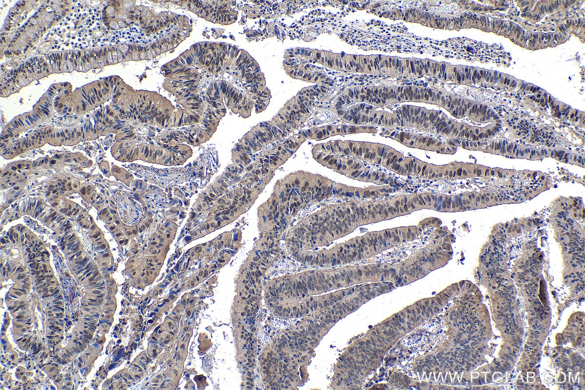 Immunohistochemical analysis of paraffin-embedded human colon cancer tissue slide using KHC1048 (PDCD6 IHC Kit).