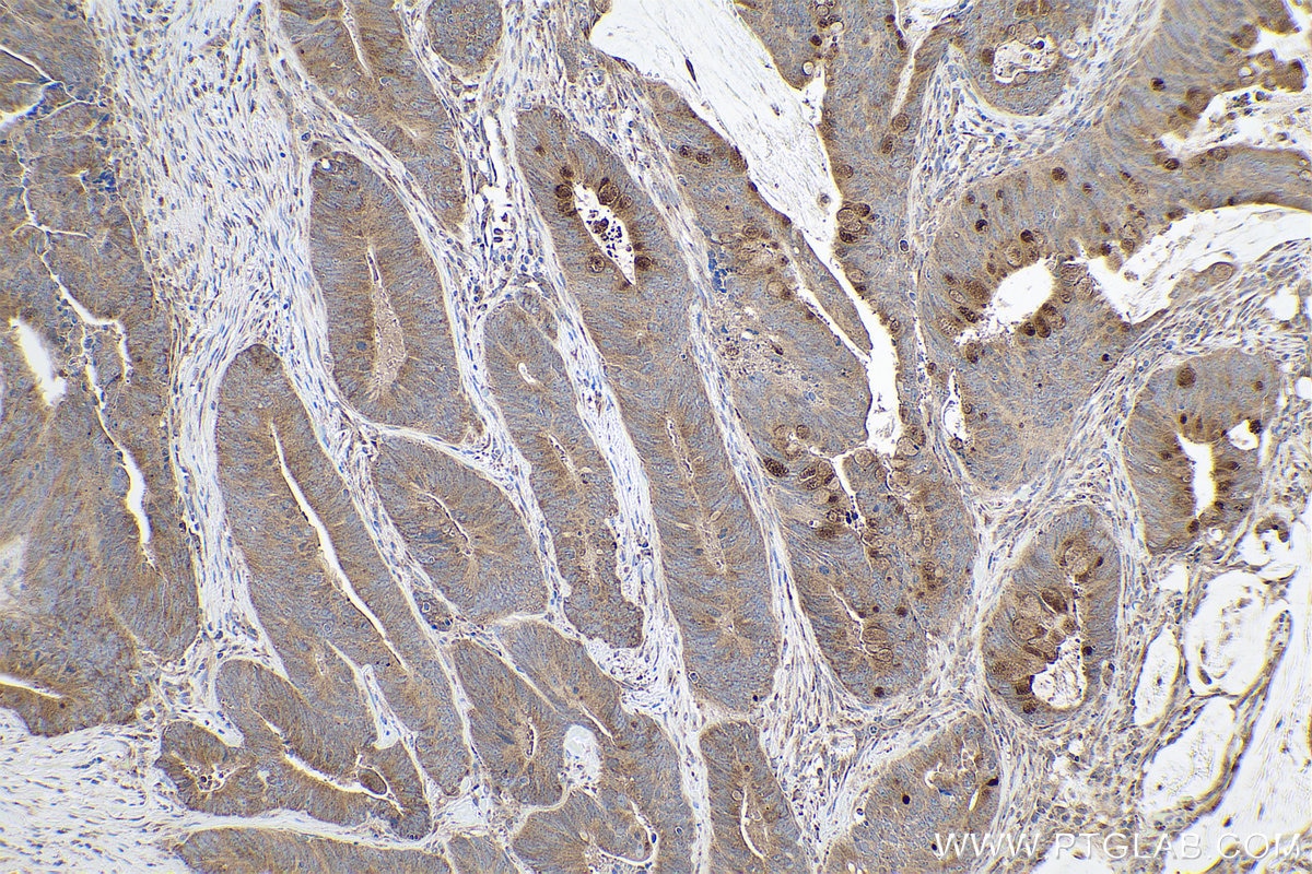 Immunohistochemical analysis of paraffin-embedded human colon cancer tissue slide using KHC0817 (PDGFRL IHC Kit).
