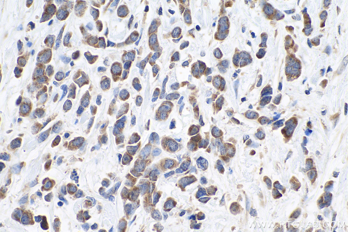 Immunohistochemical analysis of paraffin-embedded human stomach cancer tissue slide using KHC0817 (PDGFRL IHC Kit).