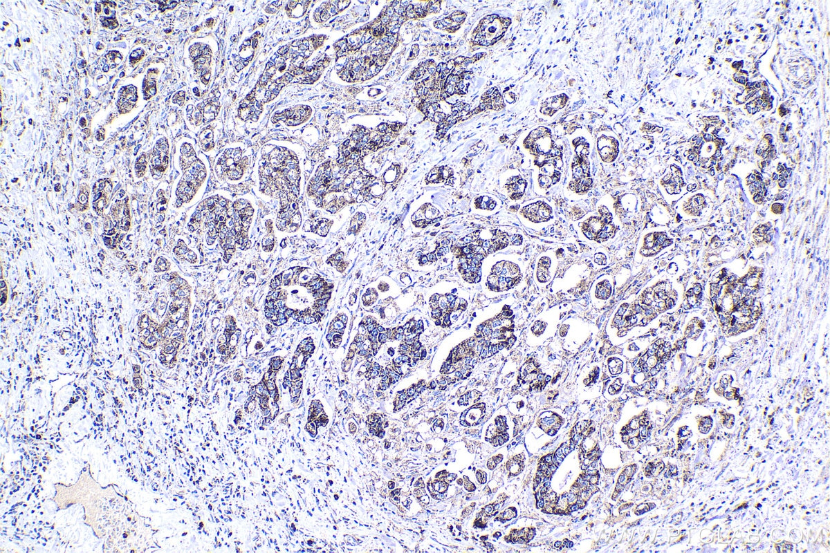 Immunohistochemical analysis of paraffin-embedded human stomach cancer tissue slide using KHC1375 (PDHX IHC Kit).