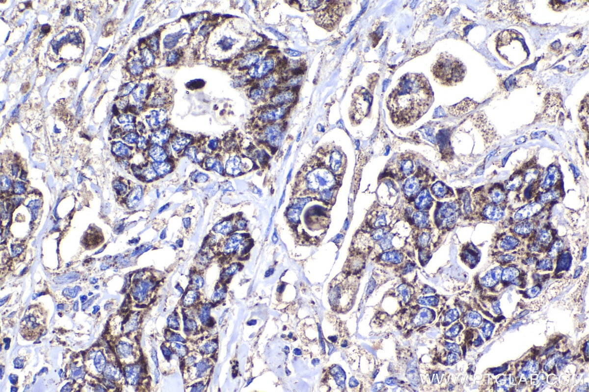Immunohistochemical analysis of paraffin-embedded human stomach cancer tissue slide using KHC1375 (PDHX IHC Kit).