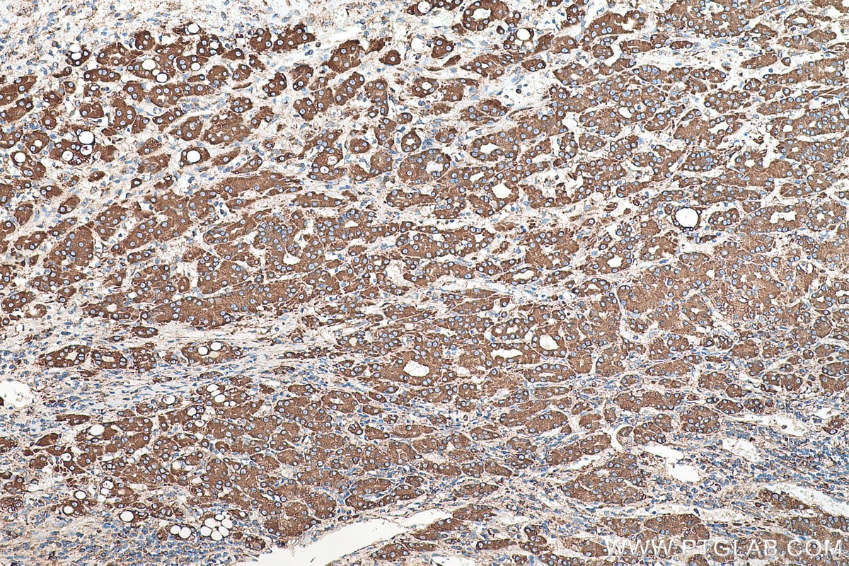 Immunohistochemical analysis of paraffin-embedded human liver cancer tissue slide using KHC0516 (PDI/P4HB IHC Kit).